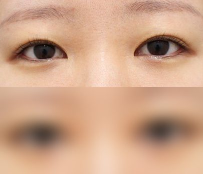 눈성형 전후사진 — 수술 후 사진은 로그인 후 확인