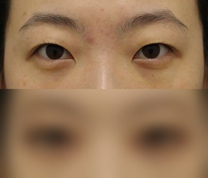 눈성형 전후사진 — 수술 후 사진은 로그인 후 확인