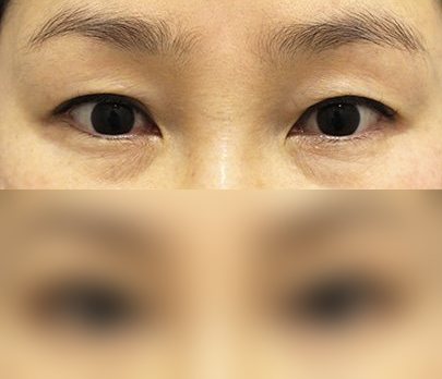 눈성형 전후사진 — 수술 후 사진은 로그인 후 확인