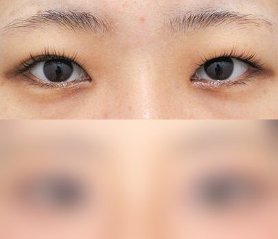 눈성형 전후사진 — 수술 후 사진은 로그인 후 확인
