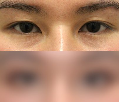 눈성형 전후사진 — 수술 후 사진은 로그인 후 확인