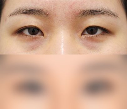 눈성형 전후사진 — 수술 후 사진은 로그인 후 확인