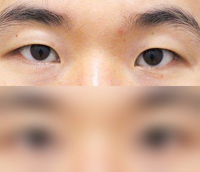 눈성형 전후사진 — 수술 후 사진은 로그인 후 확인