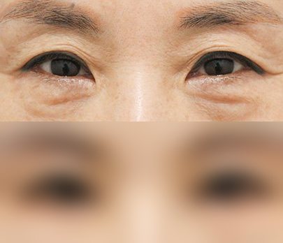 눈성형 전후사진 — 수술 후 사진은 로그인 후 확인