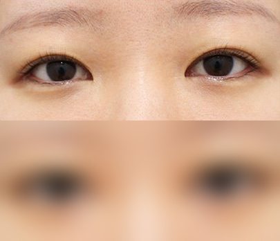 눈성형 전후사진 — 수술 후 사진은 로그인 후 확인