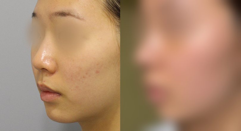 코성형 전후사진 — 수술 후 사진은 로그인 후 확인
