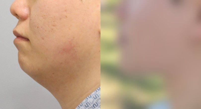 지방흡입 전후사진 — 수술 후 사진은 로그인 후 확인