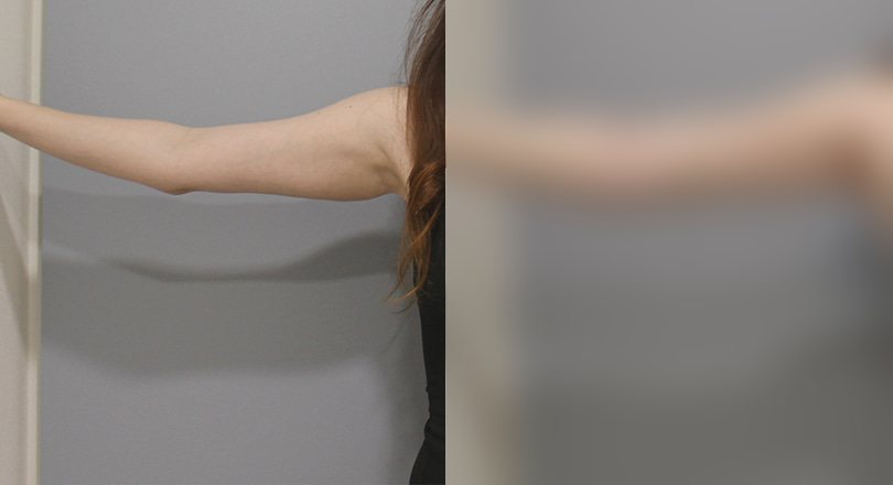 지방흡입 전후사진 — 수술 후 사진은 로그인 후 확인