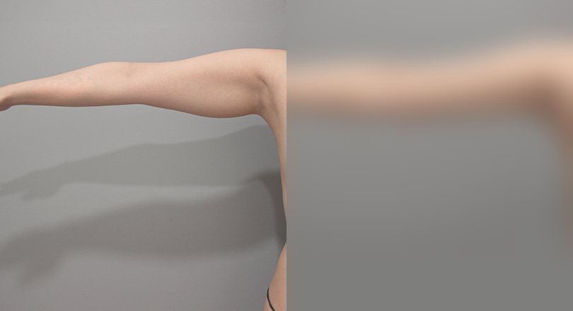 지방흡입 전후사진 — 수술 후 사진은 로그인 후 확인