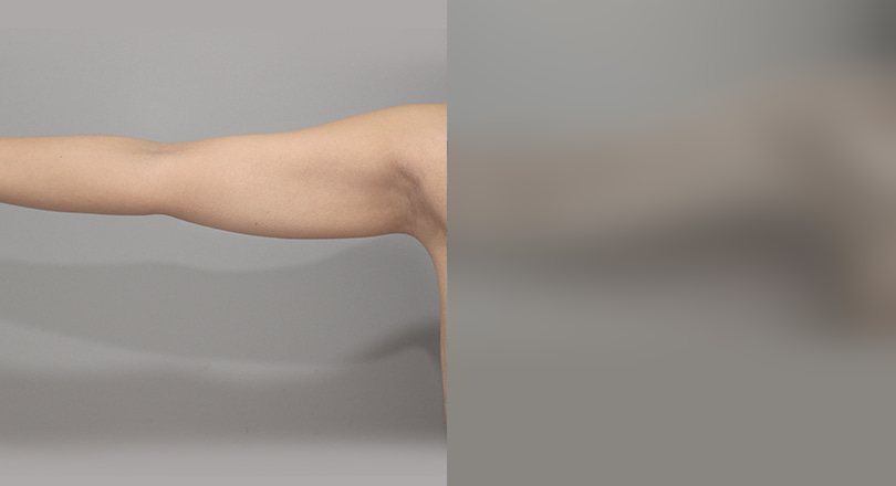 지방흡입 전후사진 — 수술 후 사진은 로그인 후 확인
