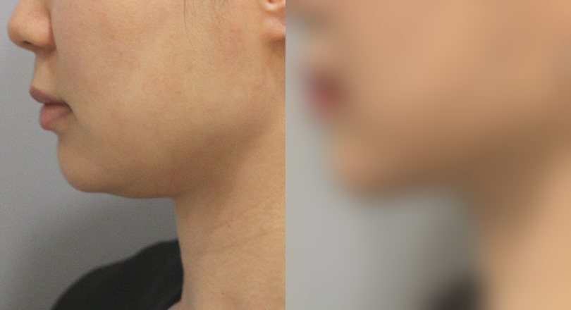 지방흡입 전후사진 — 수술 후 사진은 로그인 후 확인