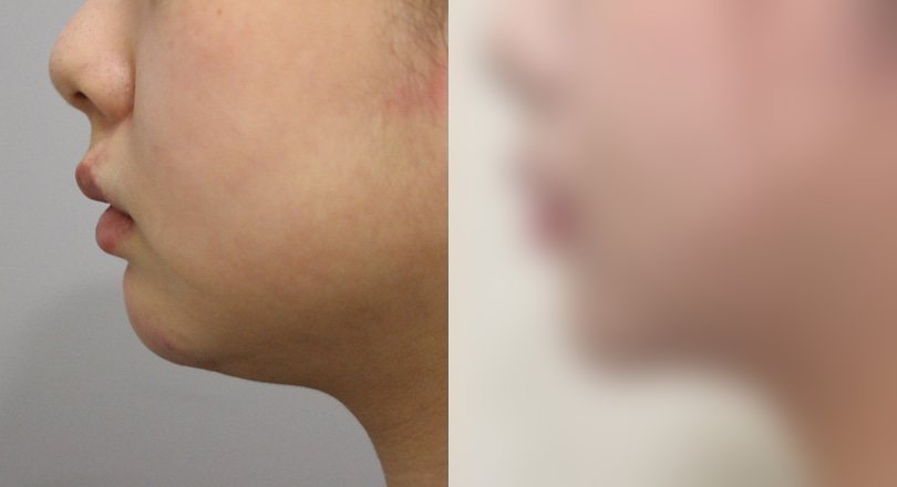 지방흡입 전후사진 — 수술 후 사진은 로그인 후 확인