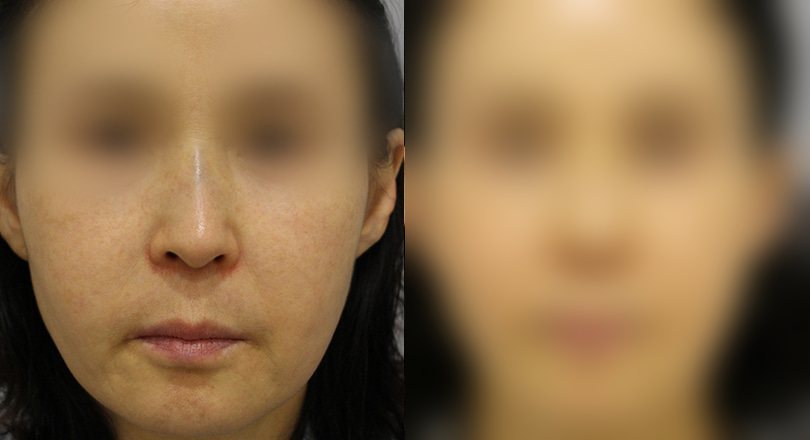 리프팅 전후사진 — 수술 후 사진은 로그인 후 확인