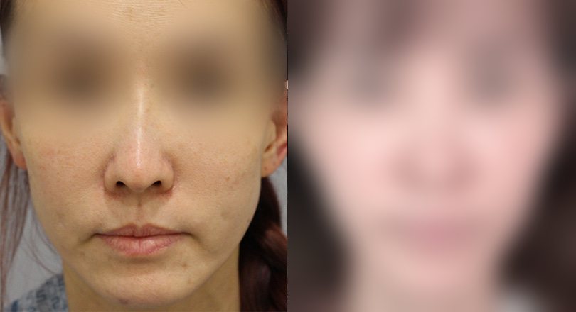 리프팅 전후사진 — 수술 후 사진은 로그인 후 확인