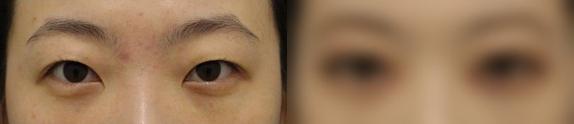 눈성형 전후 사진 2 — 눈 부위 전후 사진(양쪽 눈, 위아래 검은 띠)