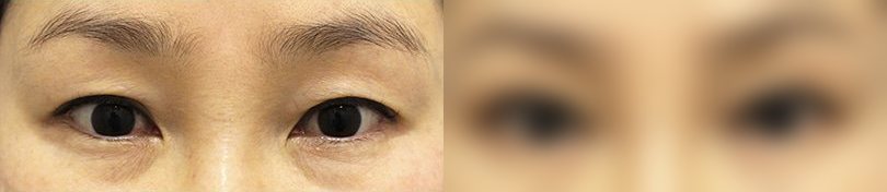 눈성형 전후 사진 3 — 눈 부위 전후 사진(양쪽 눈, 위아래 검은 띠)