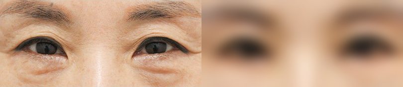 눈성형 전후 사진 8 — 눈 부위 전후 사진(양쪽 눈, 위아래 검은 띠)