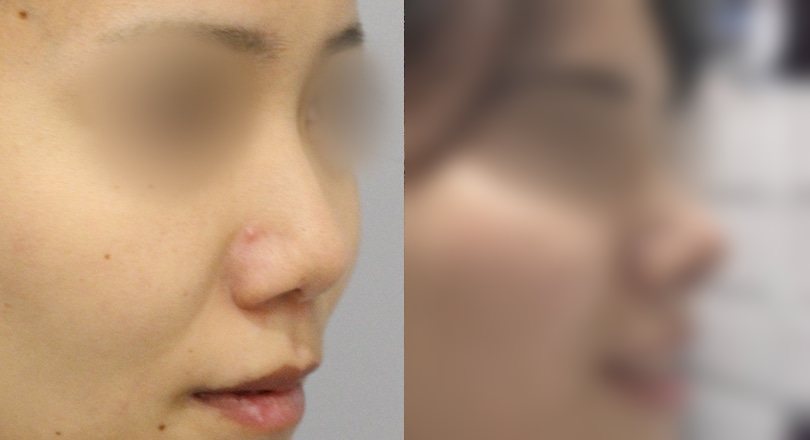 코성형 전후 사진 1 — 코 전후 사진(얼굴 일부 흐림 처리)