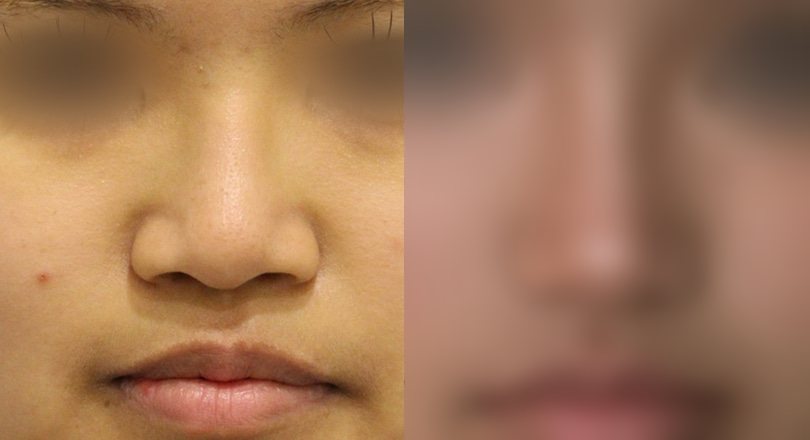 코성형 전후 사진 2 — 코 전후 사진(얼굴 일부 흐림 처리)
