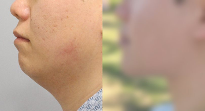 지방흡입 전후 사진 2 — 지방흡입 전후 사진(복부·턱밑·팔)
