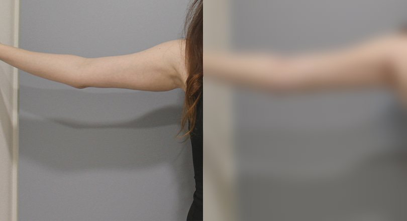 지방흡입 전후 사진 3 — 지방흡입 전후 사진(복부·턱밑·팔)