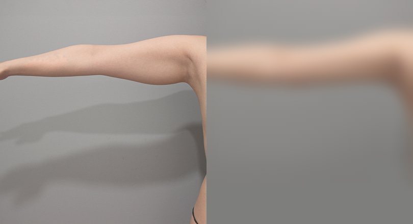 지방흡입 전후 사진 4 — 지방흡입 전후 사진(복부·턱밑·팔)