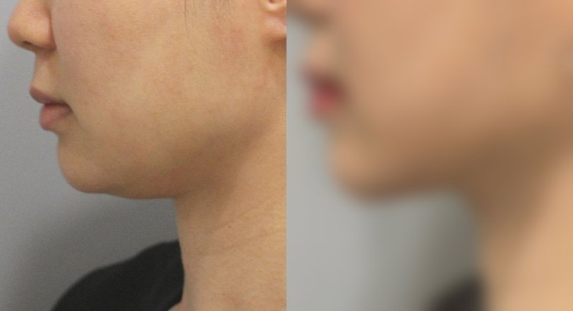 지방흡입 전후 사진 6 — 지방흡입 전후 사진(복부·턱밑·팔)