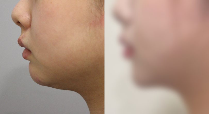 지방흡입 전후 사진 7 — 지방흡입 전후 사진(복부·턱밑·팔)
