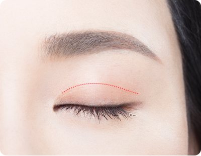 감은 눈 위 빨간 점선(절개선 위치) 사진